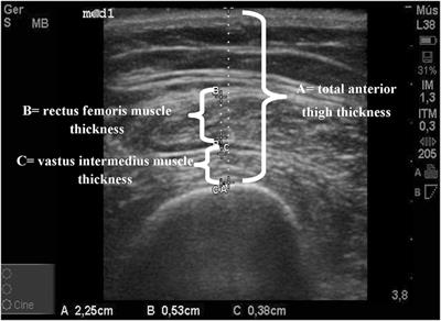 Bedside Ultrasound of Quadriceps to Predict Rehospitalization and <mark class="highlighted">Functional Decline</mark> in Hospitalized Elders